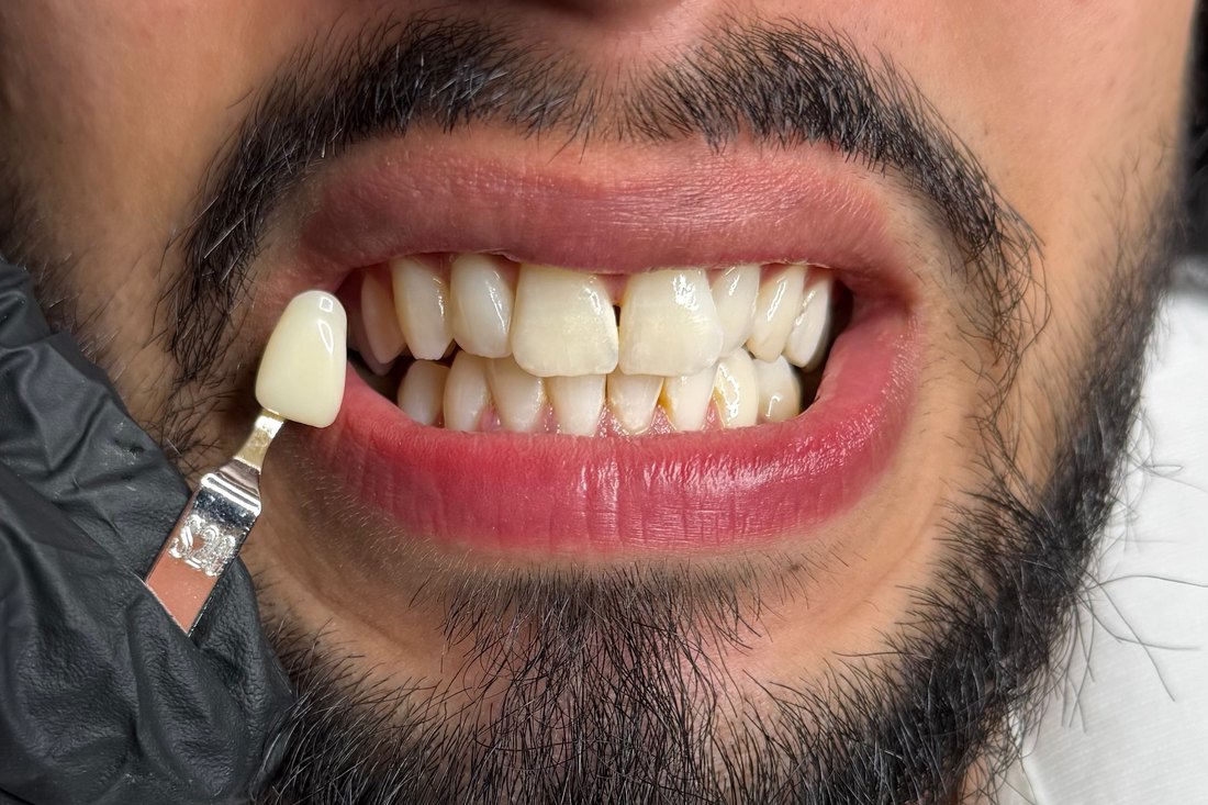Sourire après blanchiment dentaire — résultat 01 — LUXSMILE Annemasse
