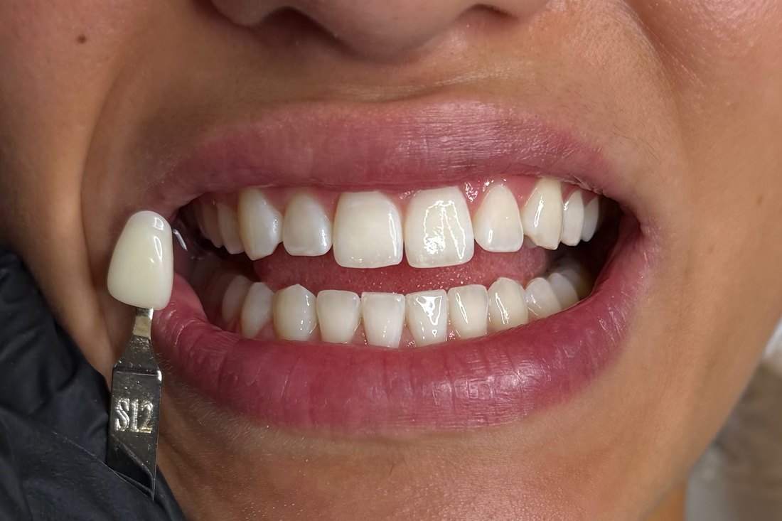 Sourire après blanchiment dentaire — résultat 02 — LUXSMILE Annemasse