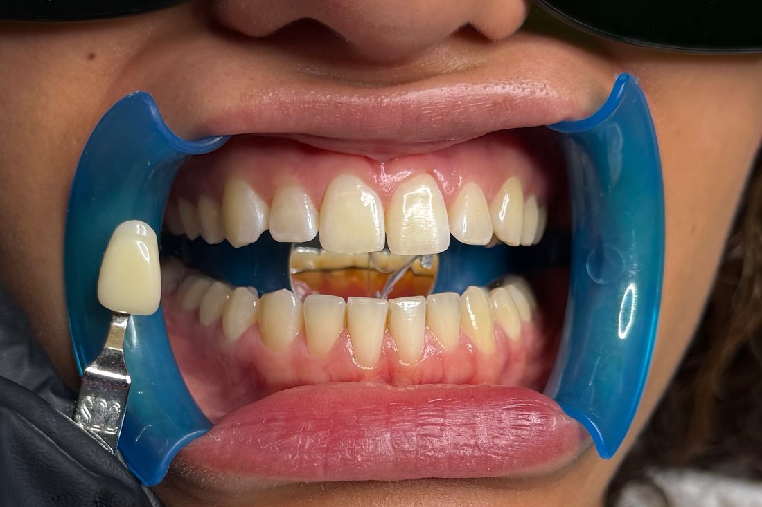 Sourire avant blanchiment dentaire — résultat 02 — LUXSMILE Annemasse