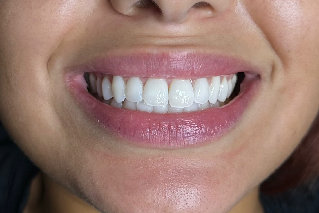 Sourire après blanchiment dentaire — résultat 03 — LUXSMILE Annemasse