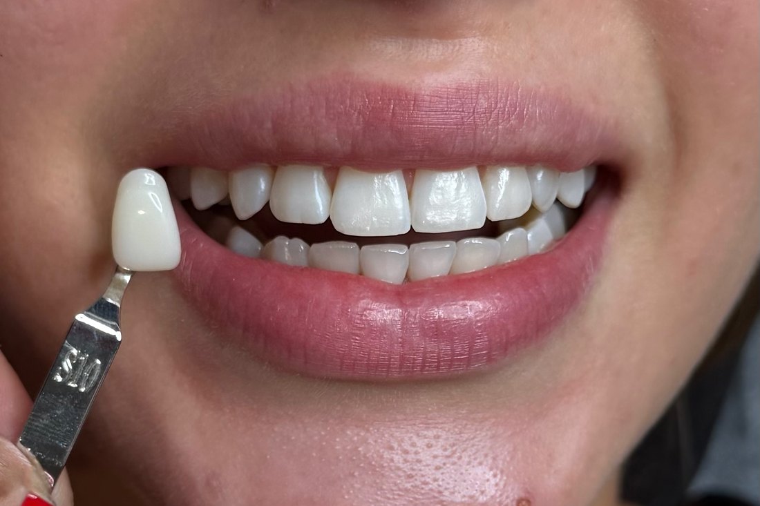 Sourire après blanchiment dentaire — résultat 04 — LUXSMILE Annemasse