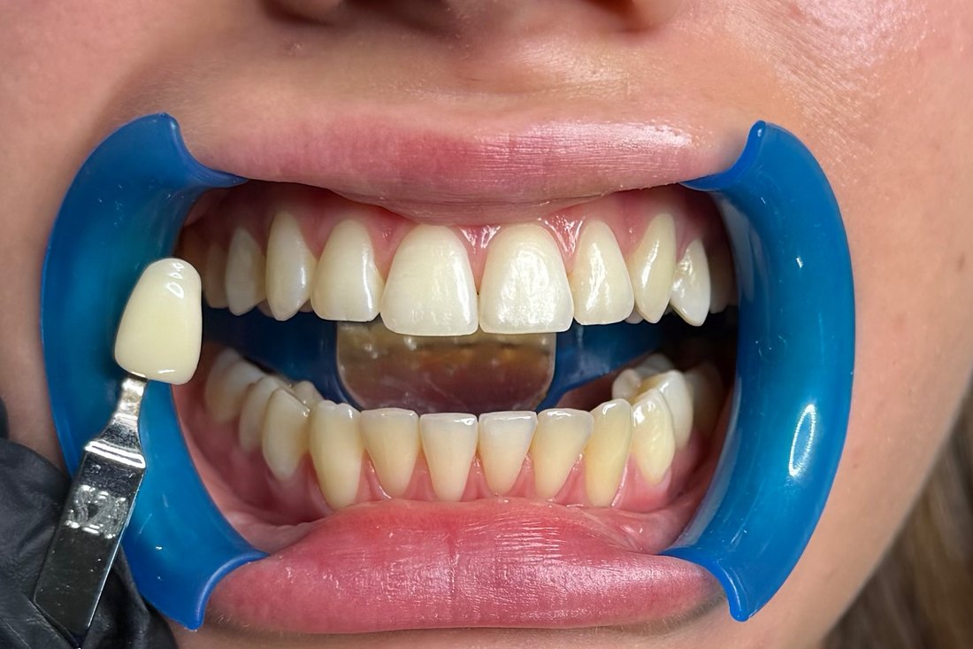 Sourire avant blanchiment dentaire — résultat 04 — LUXSMILE Annemasse